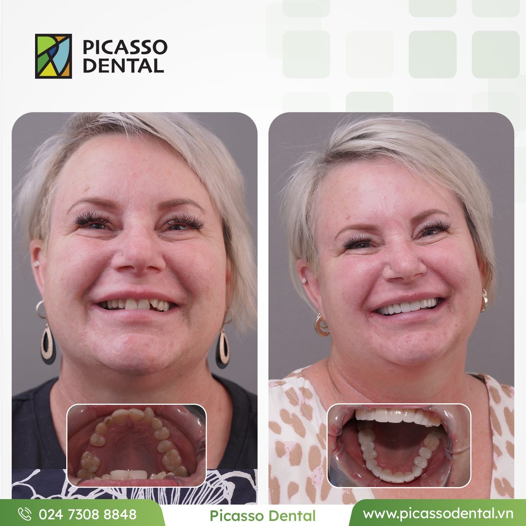 Anterior aesthetic correction — before and after result at Picasso Dental Clinic