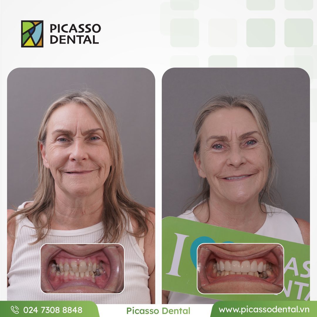 Full smile ceramic restoration — before and after result at Picasso Dental Clinic