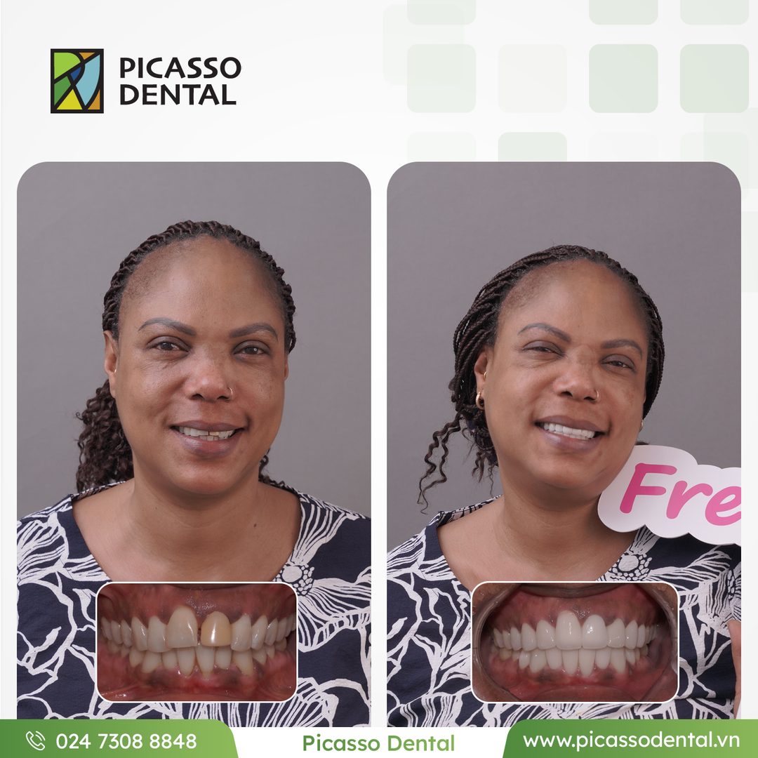 Combined ceramic restoration — before and after result at Picasso Dental Clinic